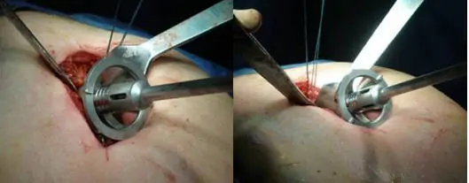 prótesis de cadera con cirugía mínimamente invasiva