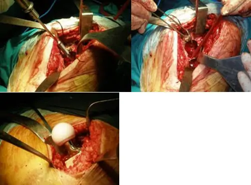 cirugía mínimamente invasiva de prótesisi de cadera