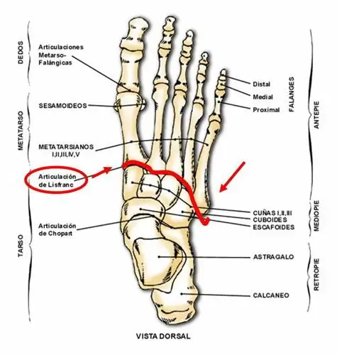 Lesiones de pie y tobillo. Lesión de la articulación de Lisfranc