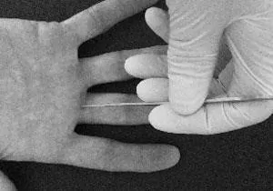 Síntomas y diagnóstico del dedo en gatillo o dedo en resorte