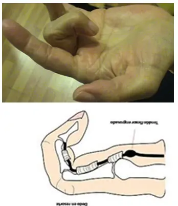Tratamiento del Dedo engatillado, dedo en resorte