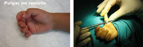 cirugía ecoguiada del dedo en gatillo o en resorte