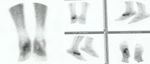 gammagrafía en la lesiones de la articulación de lisfranc