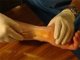 traumatología y rotura del fibrocartílago triangular de la mano