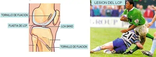 Lesiones Rodilla Ligamento Cruzado Posterior Dr. Manuel Villanueva