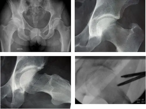 Radiografía de Bursitis Lesión de cadera por el especialista en cadera doctor villanueva