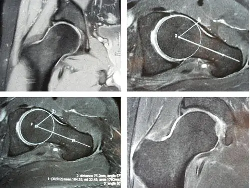 Radiografía de Bursitis Lesión de cadera por el especialista en cadera doctor villanueva