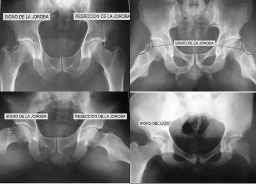 Atrapamiento o Choque Femoroacetabular (AFA) Patologia por el especialista en Protesis Cadera Dr. Villanueva