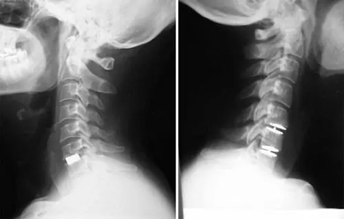 Radiografía Prótesis de Disco en Hernia Discal por el especialista en traumatología Dr. Villanueva