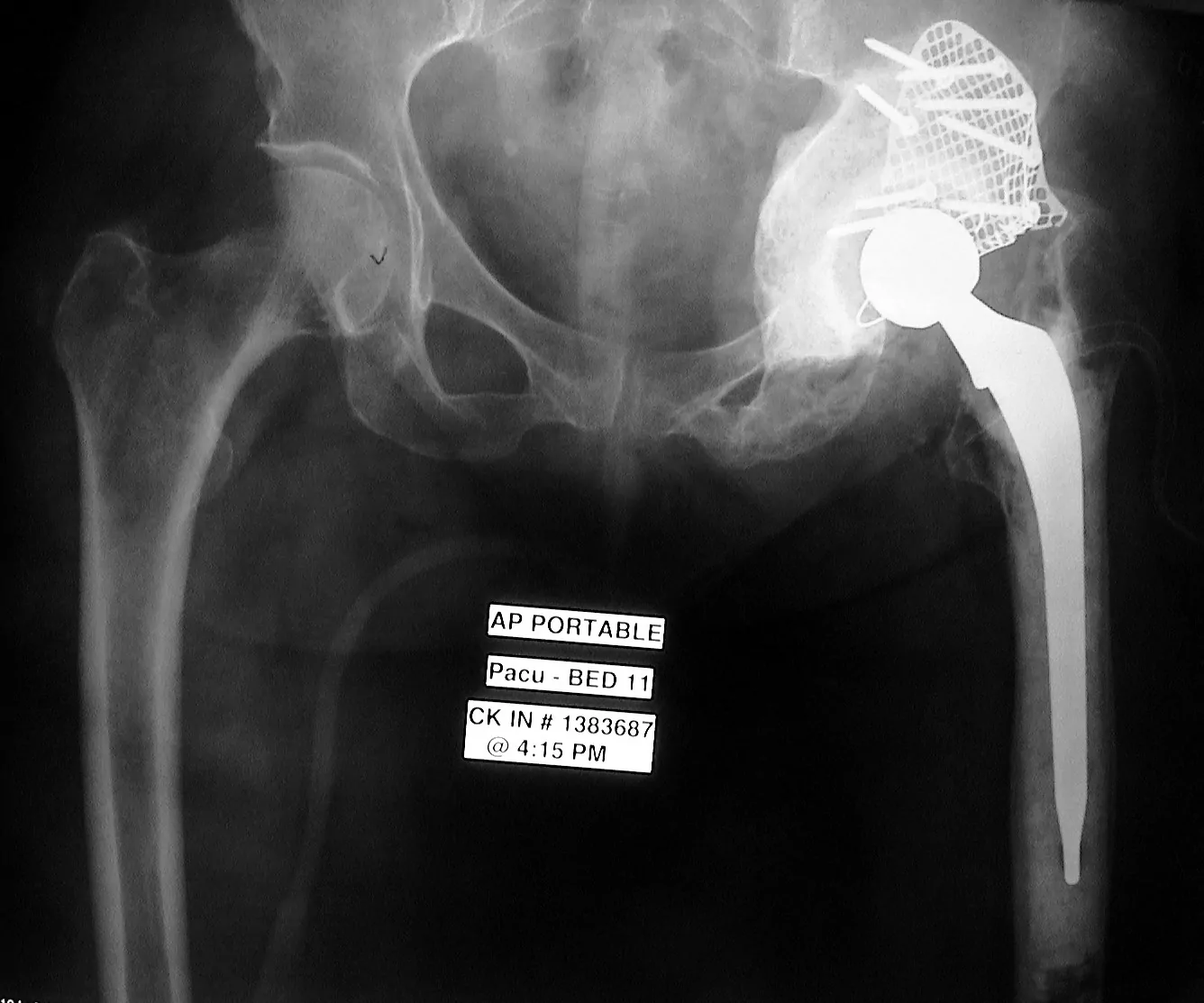 Especialista en Cirugía Ortopédica Dr. Manuel Villanueva. Defecto masivo acetabular tratado con impactación de injertos.