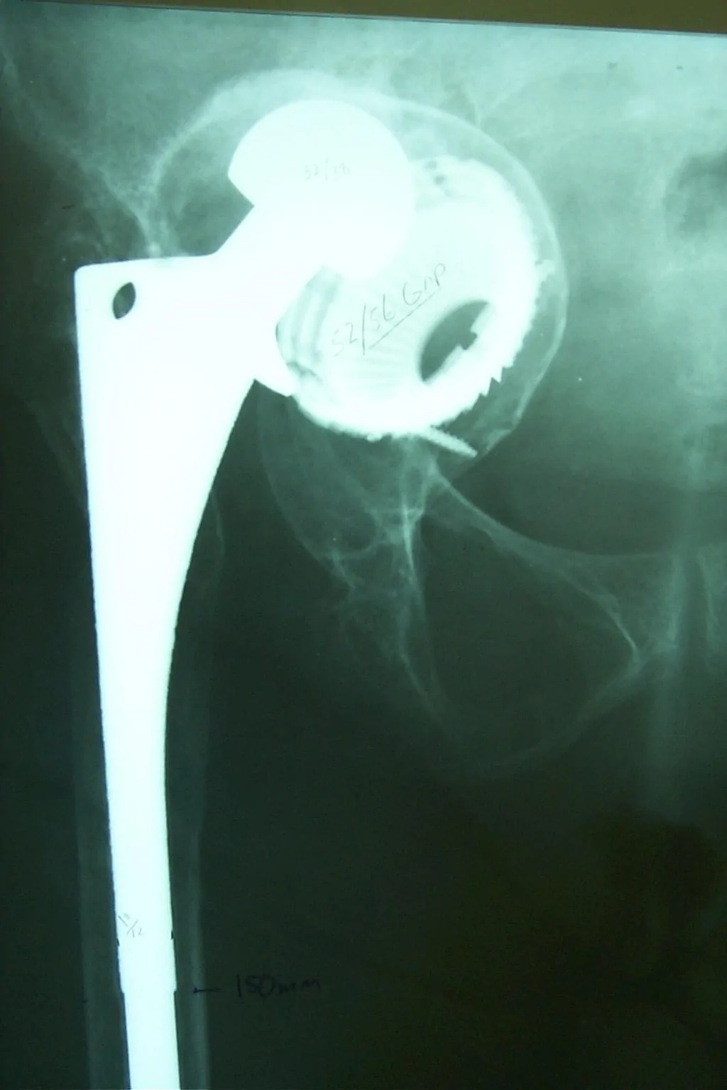 En la artroplastia de revisión de cadera en los casos de gran pérdida ósea los objetivos del cirujano son, inicialmente, restituir el centro de rotación y la biomecánica de la articulación, obtener una cadera estable y mantener la función de la extremidad. A largo plazo el objetivo es restituir la masa ósea.