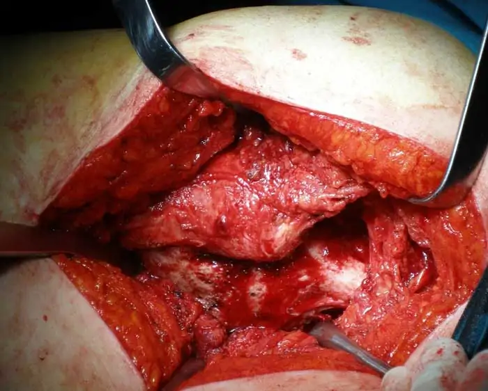 Desartrodesis de Cadera, prótesis de cadera