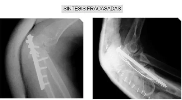 1 Cirugía y Casos Clinicos Complejos. Protesis. Fractura No consolidada e Infectada de Codo. Dr. Manuel Villanueva