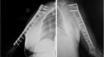 Lesiones hombro, fractura del húmero proximal. Radiografía del Dr. Manuel Villanueva especialista en traumatología y lesiones deportivas