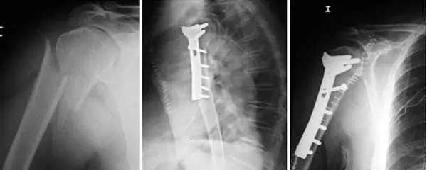 Lesiones hombro, fractura del húmero proximal. Radiografía del Dr. Manuel Villanueva especialista en traumatología y lesiones deportivas