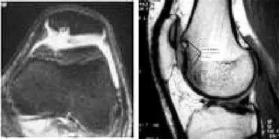 Lesiones Osteocondrales y Osteonecrosis Especialista en traumatología e infección de prótesis de rodilla Dr. Manuel Villanueva