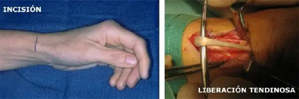 Lesiones de la mano: Tenosinovitis De Quervain