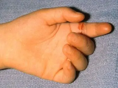 Lesión de tendones flexores del 2º dedo de la mano