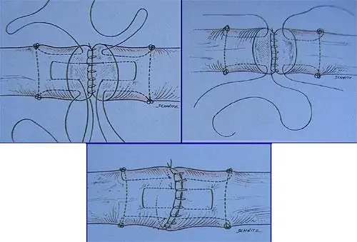 Técnica Indiana (4 bandas): Strickland 1993 de los tendones flexores y extensores de la mano