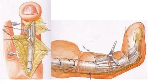 Ejemplo gráfico de sutura de tendones flexores en la zona II