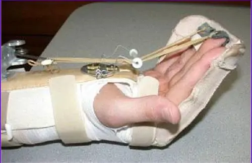 Inmovilizador de los tendones flexores y extensores de la mano