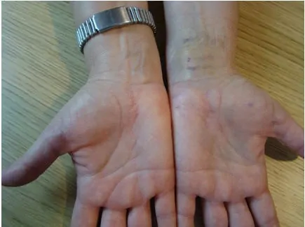 Tratamiento con Cirugía del túnel del Carpo de las dos manos a la vez. Sin puntos y sin isquemia