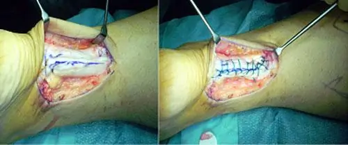 Lesiones de tobillo y pie: Rotura del tendón de Aquiles