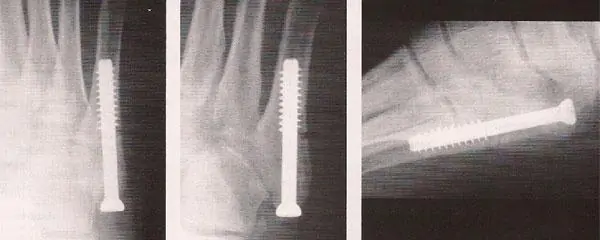 Lesiones de tobillo y pie: radiografía de Fractura de la cola del Quinto Metatarsiano