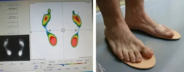 Lesiones del pie: tratamiento de la metatarsalgia