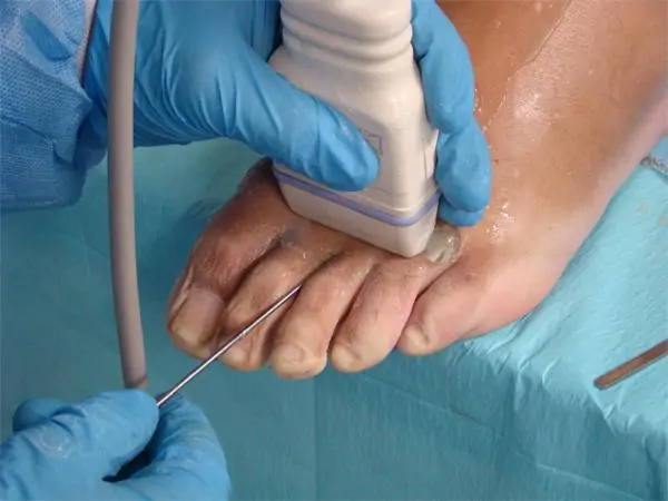 Cirugía ultra-mínimamente invasiva guiada por ecografía del Neuroma de Morton por el Doctor Villanueva