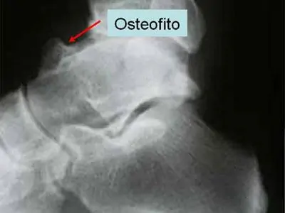 Osteofito anterior. Síndrome óseo de impactación o pinzamiento anterior