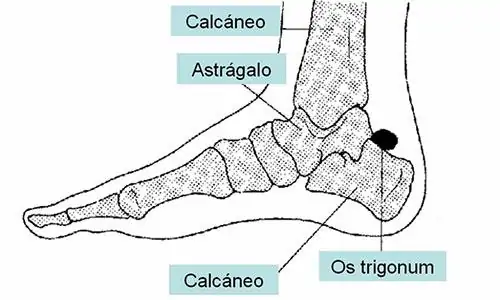 Síndrome óseo de impactación o pinzamiento anterior. síndrome de pinzamiento anterior. Lesion Pie Tobillo y pie por el especialista en lesiones deportivas y traumatología Dr. Manuel Villanueva