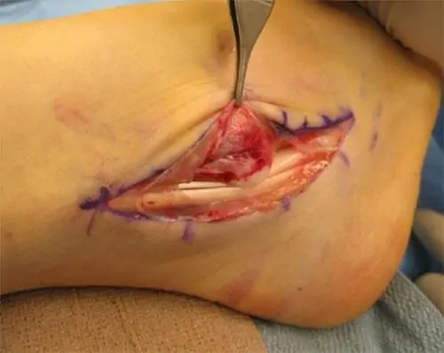 2020 Lesiones de los tendones peroneos del tobillo