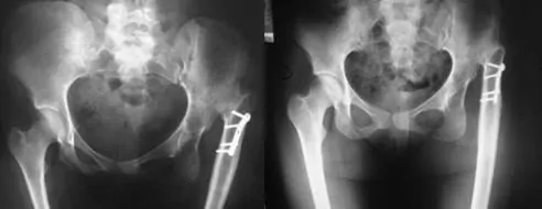 Prótesis de Cadera. Displasia alta (Crowe IV) de la cadera por el especialista en traumatología y cirugía ortopédica Dr. Manuel Villanueva