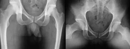 Dolor de cadera en paciente joven por especialista en prótesis de cadera doctor villanueva