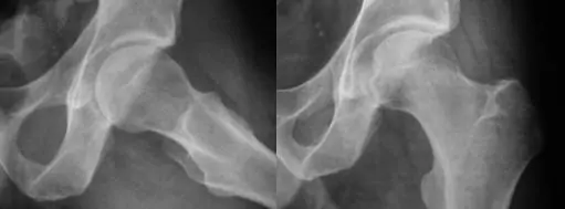 Radiografía del atrapamiento o choque femoroacetabular por el experto en lesiones de cadera, Doctor Villanueva