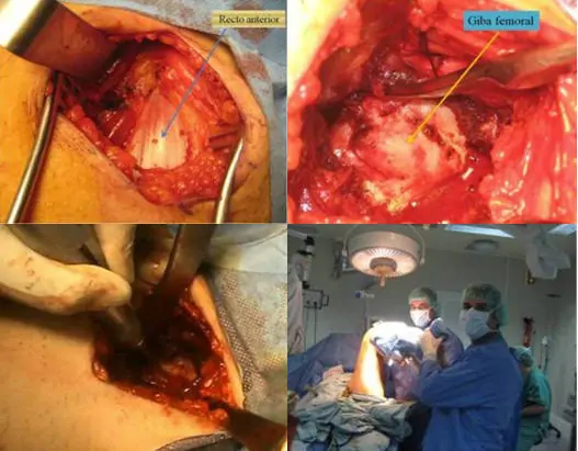 Atrapamiento o Choque Femoroacetabular (AFA) Patologia por el especialista en Protesis Cadera Dr. Villanueva