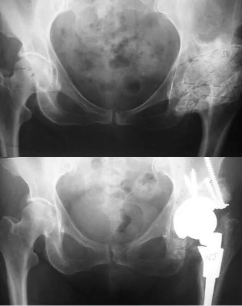 Conversión de artrodesis en prótesis total de cadera. Premio de la Academia Americana de Cirujanos Ortopédicos al especialista en traumatología y prótesis de cadera, Dr. Manuel Villanueva
