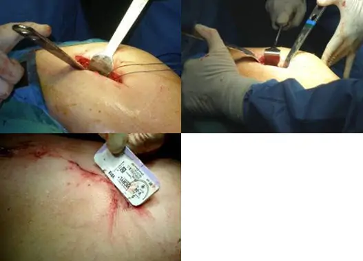 Cirugía Minimamente Invasiva MIS Prótesis Cadera y Rodilla Dr. Manuel Villanueva