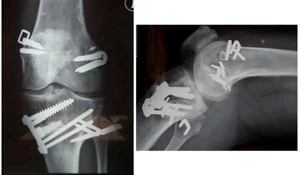 Control radiológico tras cirugía por lesión compleja de ligamentos y meniscos.