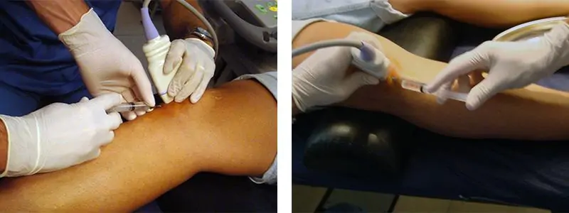 Lesiones Rodilla Tendinopatía de Rodilla o rodilla de Saltador por el especialista en traumatología Dr. Manuel Villanueva