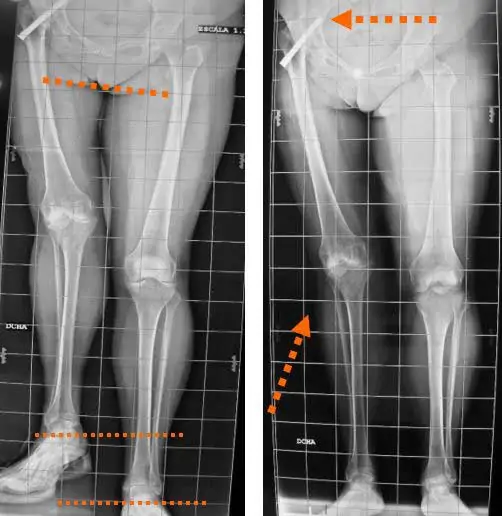 Desartrodesis de Cadera, prótesis de cadera