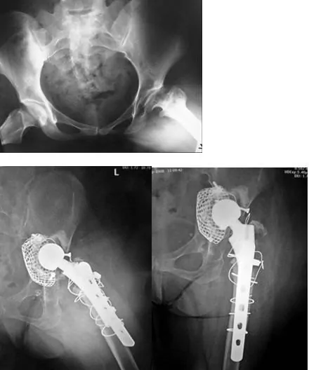 radiografía de prótesis de cadera