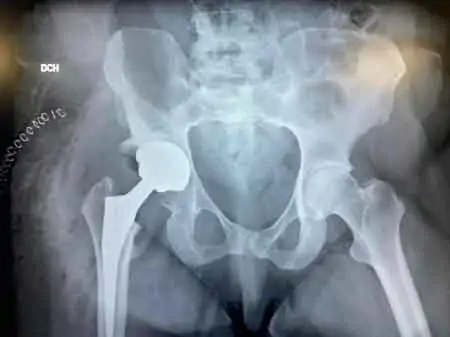 Radiografía-de cadera-con-displasia-severa
