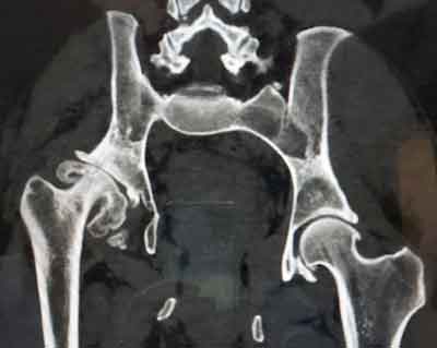 Radiografía-de cadera-con-displasia-severa
